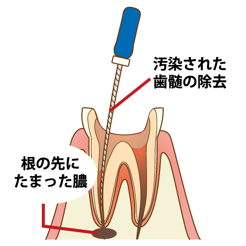 根管治療の進め方