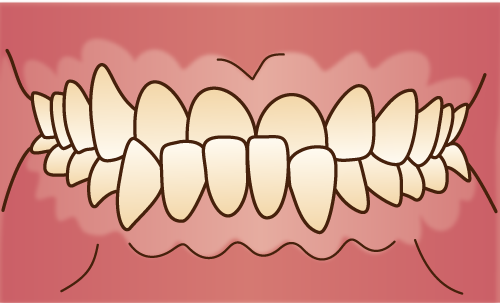 下顎前突（受け口）