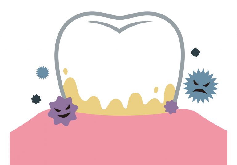 歯を失う原因第一位「歯周病」