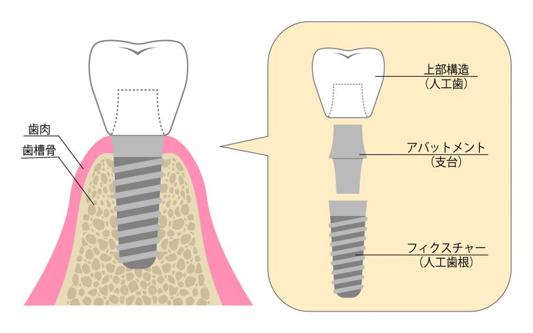 インプラントとは？