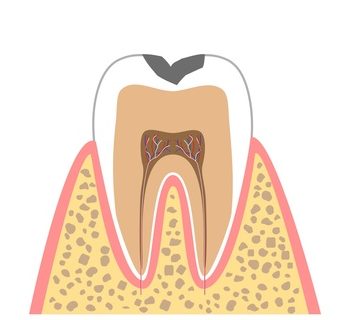 むし歯の進行