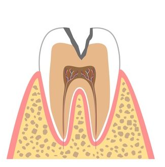 むし歯の進行