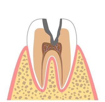 むし歯の進行