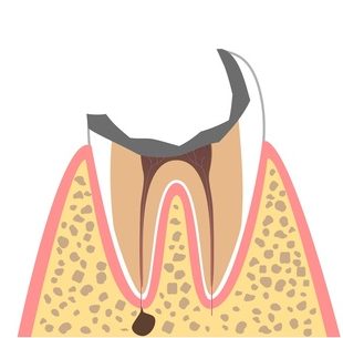むし歯の進行